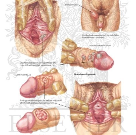 Sexually Transmitted Diseases Std