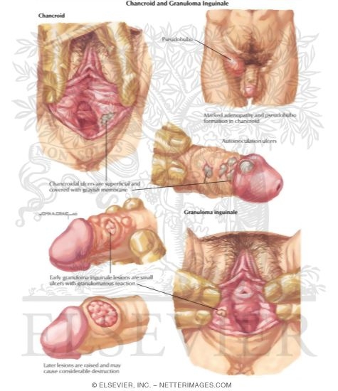 Sex Diease 106